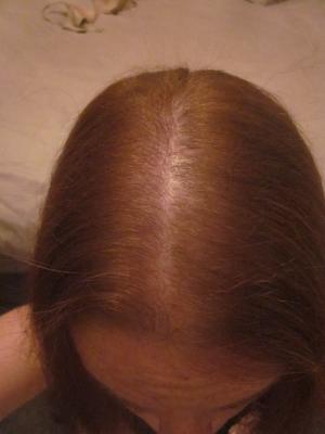 Nats Stunning Hair Regrowth Pictures