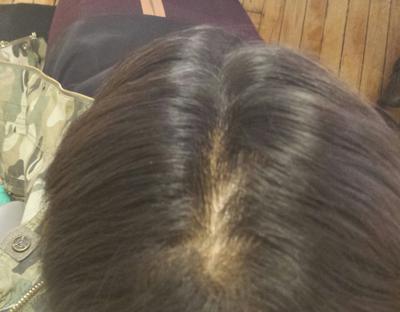  Thyroid And Hair Loss with Gluten Thyroid Hair Loss Photo Ideas With