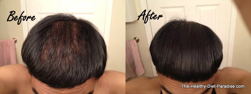 Brian's before and after regrowth story