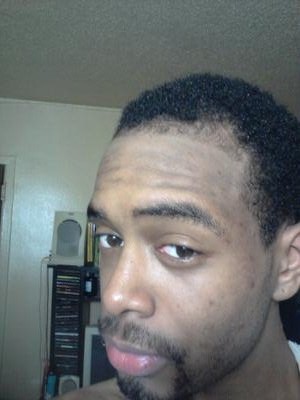 Left Side View of Hair Regrowth