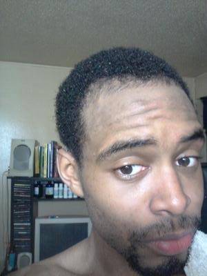 Right Side View of Hair Regrowth