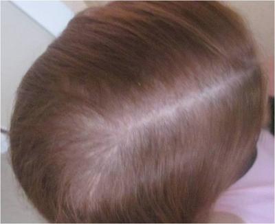 After Hair Regrowth (December 2012)