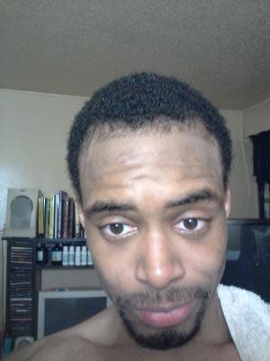 Frontal View of Hair Regrowth