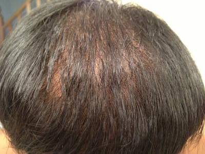 Brian S Before And After Hair Regrowth Pictures