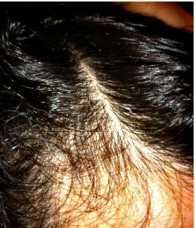 DeeDee's hair regrowth picture side view