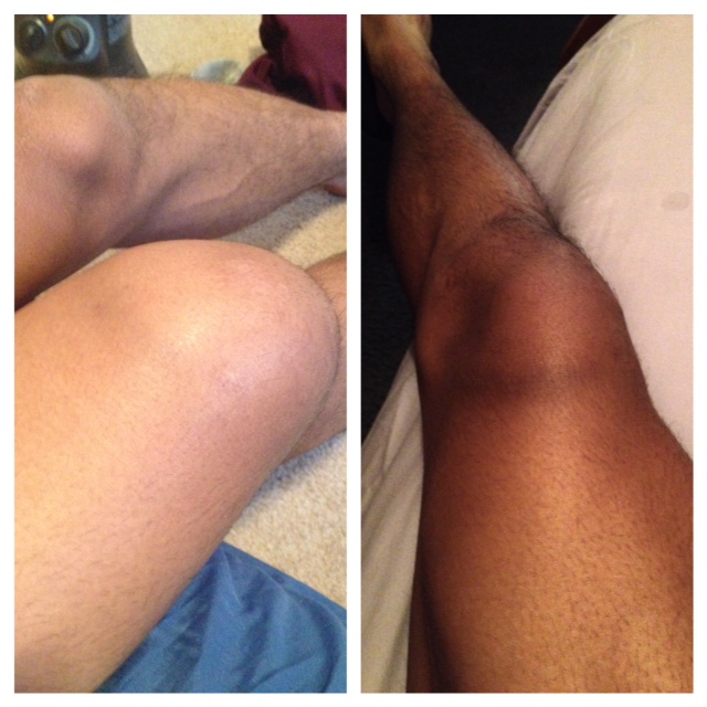 Before and after picture showing swelling from football injury
