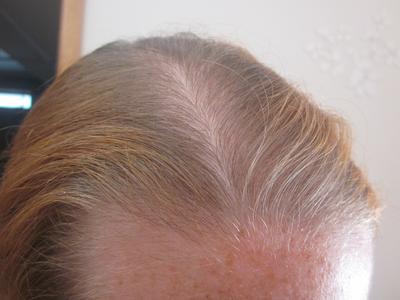 Nat S Hair Loss Survival Story