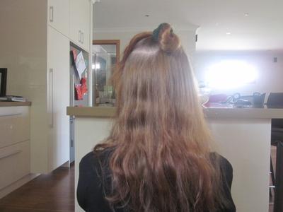Nat S Hair Loss Survival Story