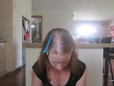 Nat S Hair Loss Survival Story